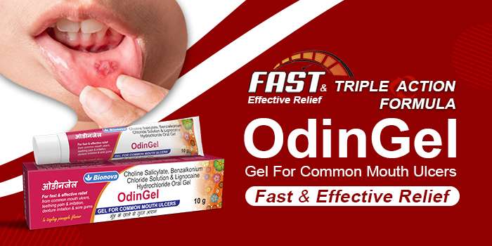 Treatment for mouth ulcers